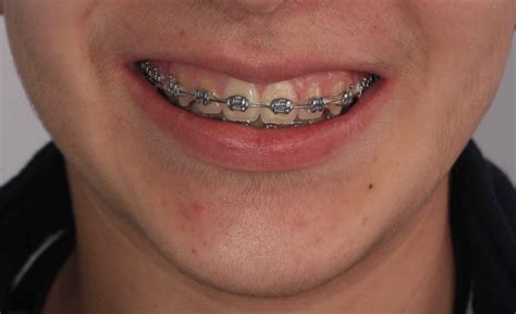 costo de los brackets metalicos|brackets linguales precio.